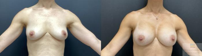 Before & After Breast Augmentation Case 76 Front View in Rochester, NY