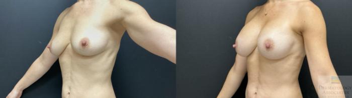 Before & After Breast Augmentation Case 76 Left Oblique View in Rochester, NY