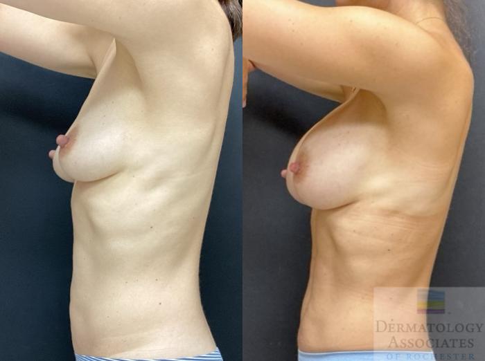 Before & After Breast Augmentation Case 76 Left Side View in Rochester, NY