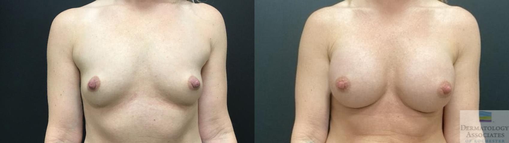 Before & After Breast Augmentation Case 78 Front View in Rochester, NY