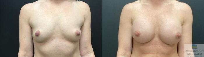 Before & After Breast Augmentation Case 78 Front View in Rochester, NY