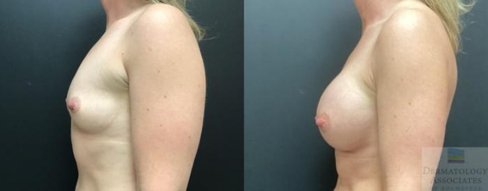 Before & After Breast Augmentation Case 78 Left Side View in Rochester, NY