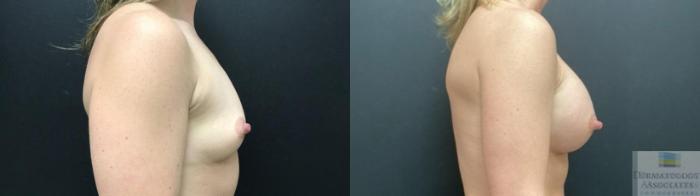 Before & After Breast Augmentation Case 78 Right Side View in Rochester, NY
