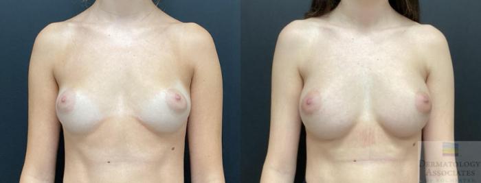 Before & After Breast Augmentation Case 85 Front View in Rochester, NY