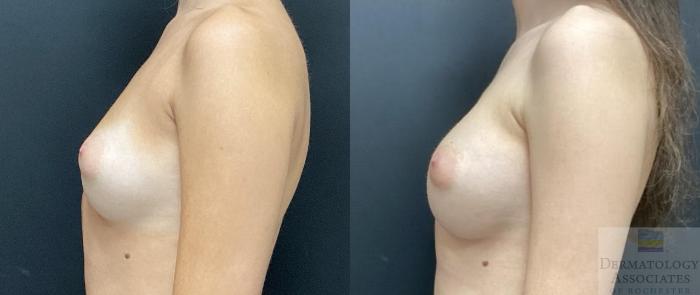 Before & After Breast Augmentation Case 85 Left Side View in Rochester, NY