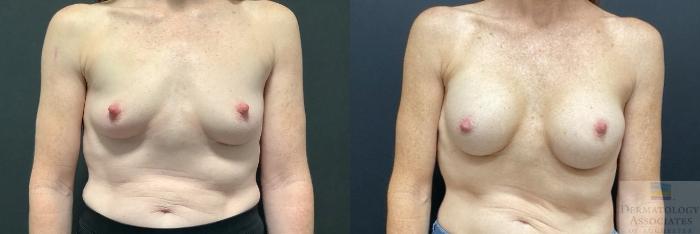 Before & After Breast Augmentation Case 88 Front View in Rochester, NY