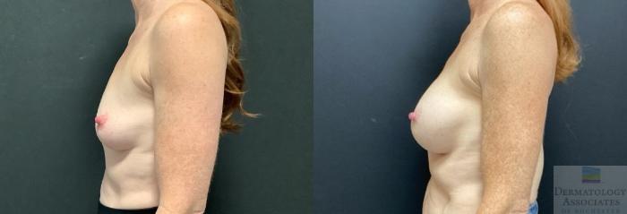 Before & After Breast Augmentation Case 88 Left Side View in Rochester, NY