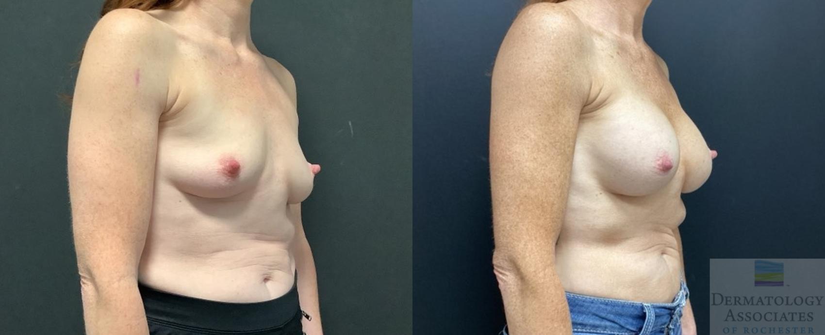 Before & After Breast Augmentation Case 88 Right Side View in Rochester, NY