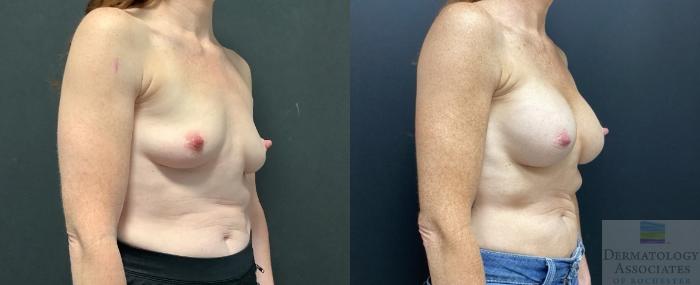 Before & After Breast Augmentation Case 88 Right Side View in Rochester, NY