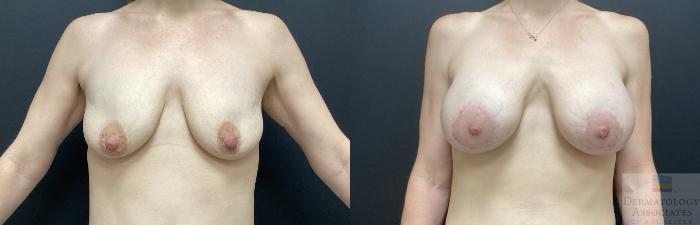Before & After Breast Augmentation Case 89 Front View in Rochester, NY