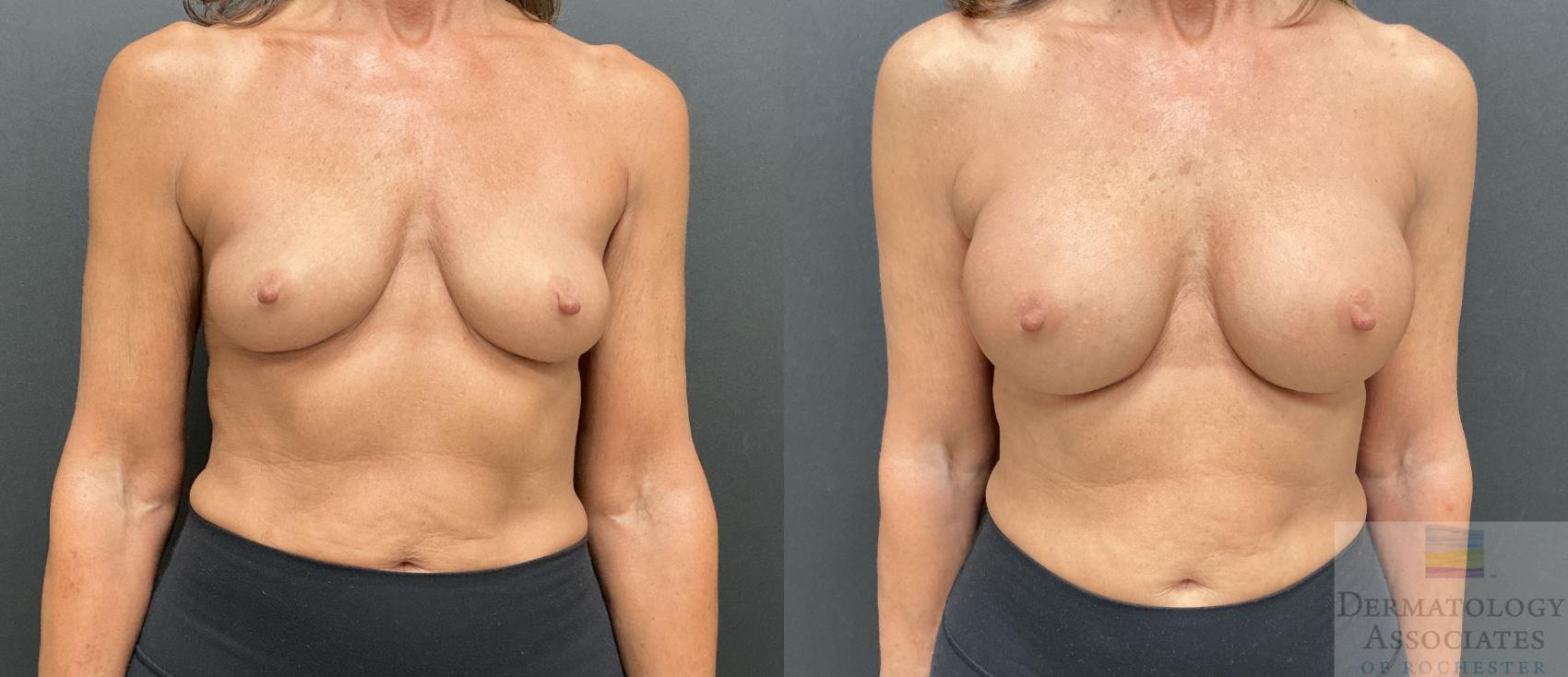 Before & After Breast Augmentation Case 91 Front View in Rochester, NY