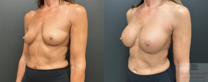 Before & After Breast Augmentation Case 91 Left Angle View in Rochester, NY
