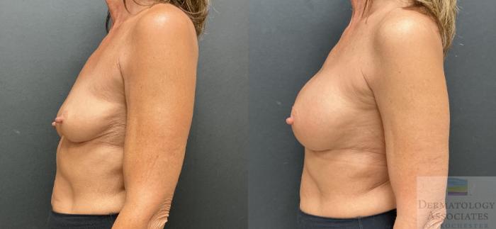 Before & After Breast Augmentation Case 91 Left Side View in Rochester, NY