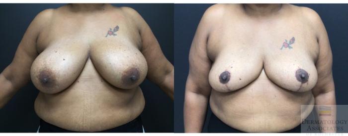 Before & After Breast reduction Case 15 Front View in Rochester, NY