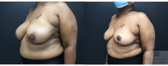 Before & After Breast reduction Case 15 Left Oblique View in Rochester, NY