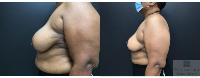 Before & After Breast reduction Case 15 Left Side View in Rochester, NY