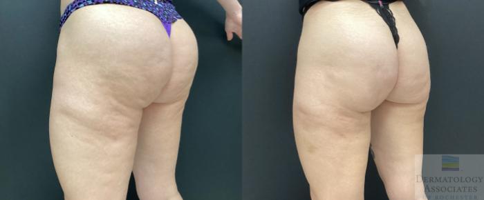 Before & After Cellulite - Aveli Case 71 Left Side View in Rochester, NY