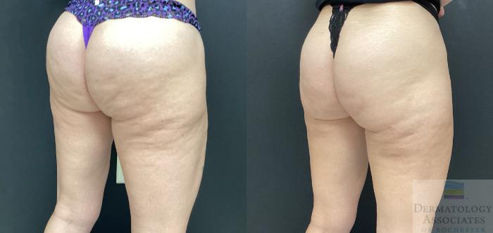 Before & After Cellulite - Aveli Case 71 Right Side View in Rochester, NY