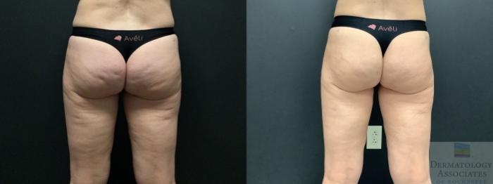 Before & After Cellulite - Aveli Case 8 Back View in Rochester, NY