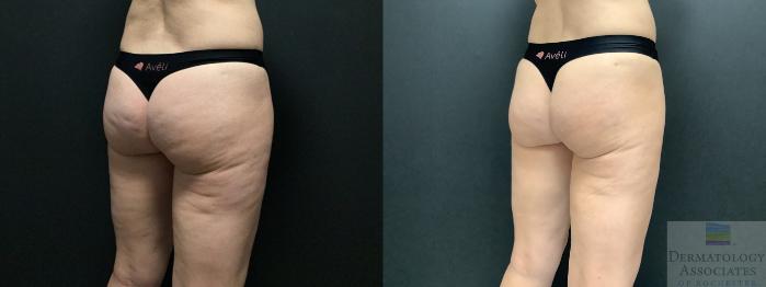 Before & After Cellulite - Aveli Case 8 Right Oblique View in Rochester, NY