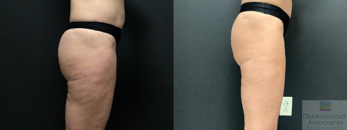 Before & After Cellulite - Aveli Case 8 Right Side View in Rochester, NY