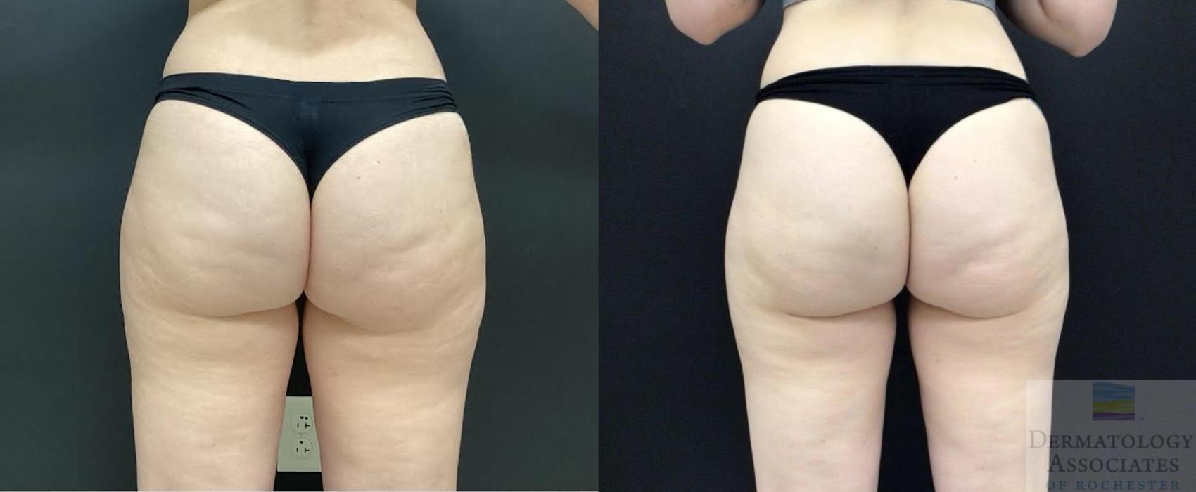 Before & After Cellulite - Aveli Case 87 Back View in Rochester, NY