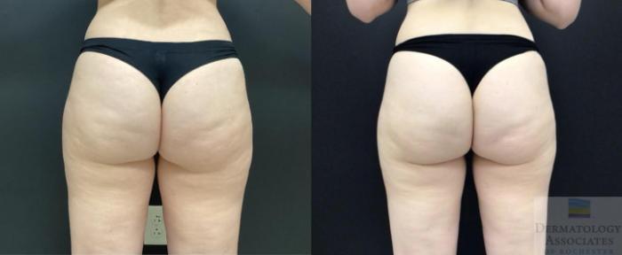 Before & After Cellulite - Aveli Case 87 Back View in Rochester, NY