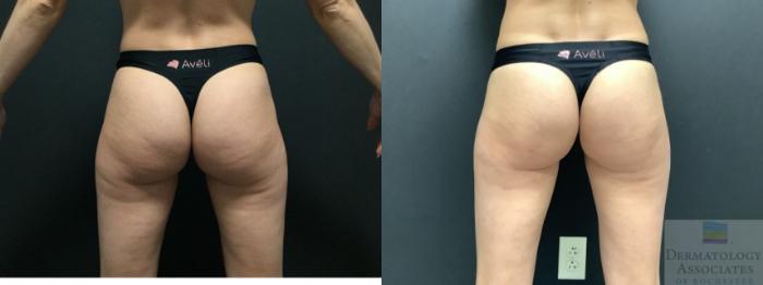 Before & After Cellulite - Aveli Case 9 Back View in Rochester, NY