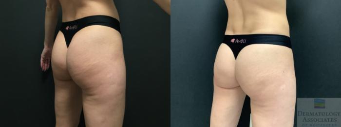 Before & After Cellulite - Aveli Case 9 Right Oblique View in Rochester, NY