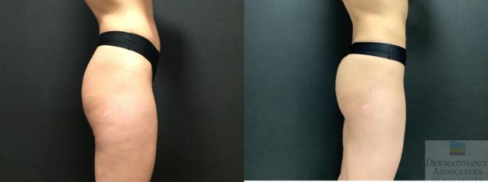 Before & After Cellulite - Aveli Case 9 Right Side View in Rochester, NY