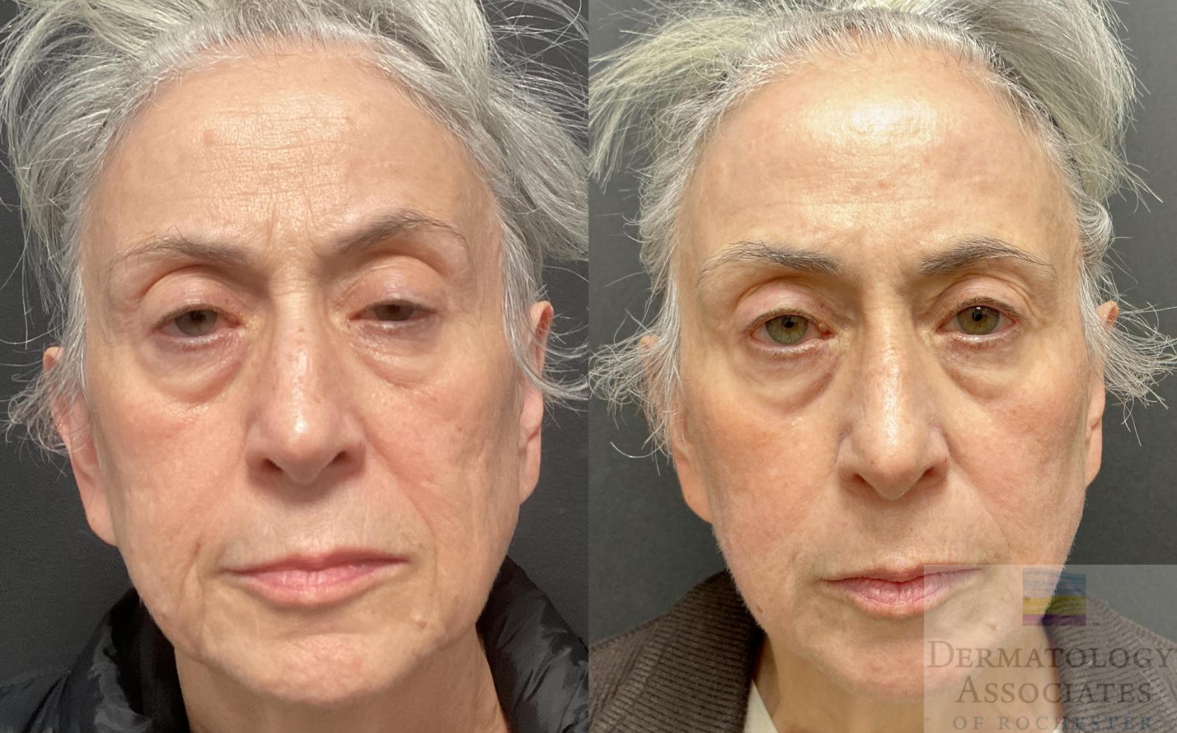 Before & After Contour TRL Case 104 Front View in Rochester, NY