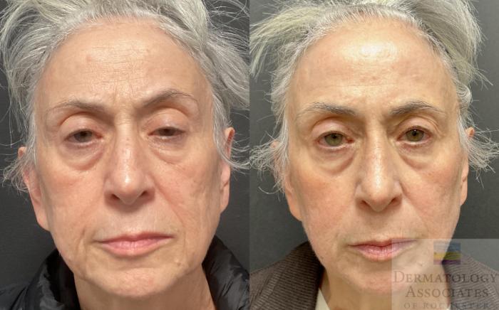 Before & After Contour TRL Case 104 Front View in Rochester, NY