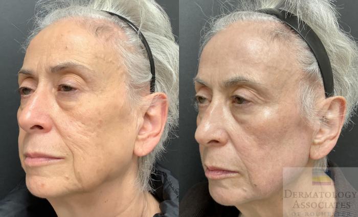 Before & After Contour TRL Case 104 Left Side View in Rochester, NY