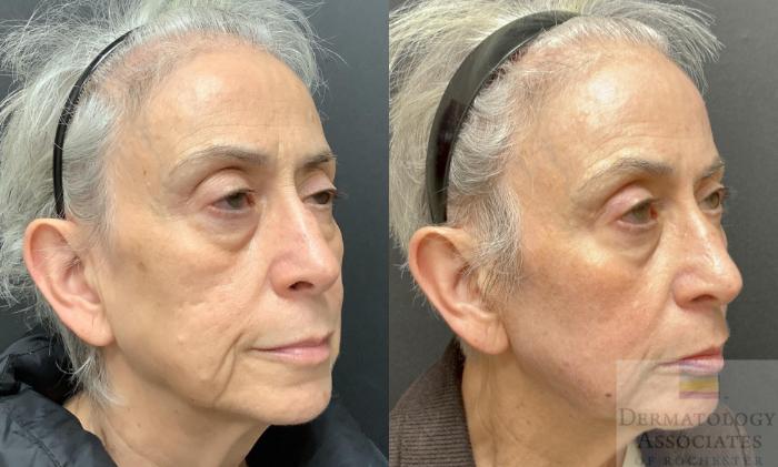 Before & After Contour TRL Case 104 Right Side View in Rochester, NY