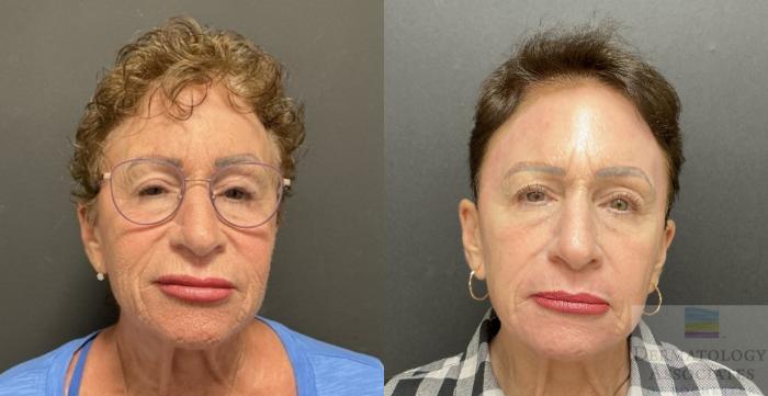 Before & After Contour TRL Case 90 Front View in Rochester, NY