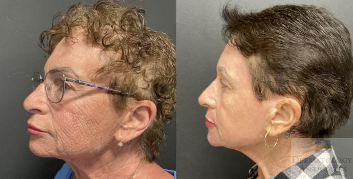 Before & After Contour TRL Case 90 Left Side View in Rochester, NY