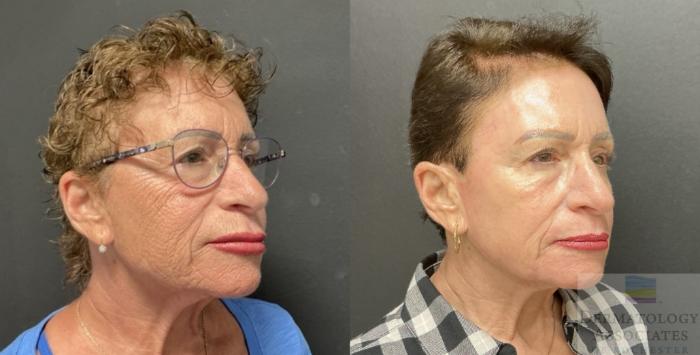 Before & After Contour TRL Case 90 Right Side View in Rochester, NY