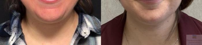 Before & After Coolsculpting Case 100 Front View in Rochester, NY