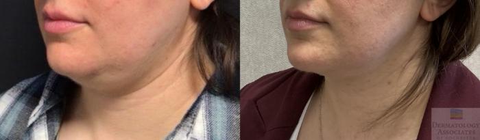 Before & After Coolsculpting Case 100 Left Angle View in Rochester, NY