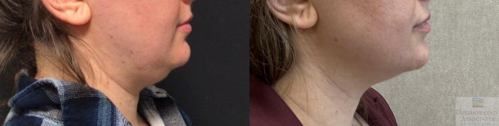 Before & After Coolsculpting Case 100 Right Side View in Rochester, NY