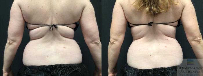 Before & After Coolsculpting Case 31 Back View in Rochester, NY