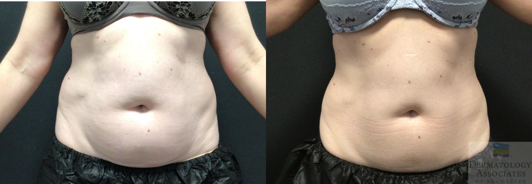 Before & After Coolsculpting Case 31 Front View in Rochester, NY