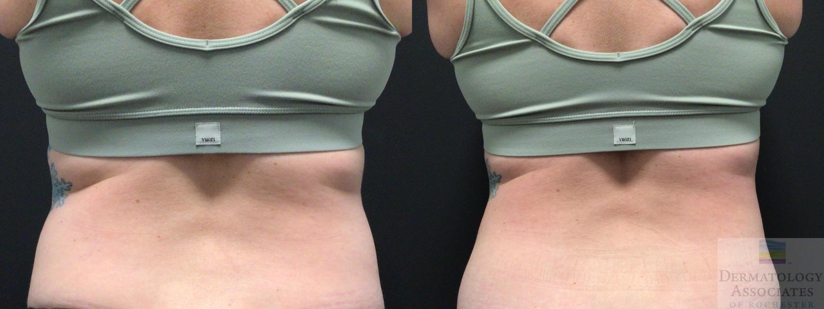 Before & After Coolsculpting Case 33 Back View in Rochester, NY
