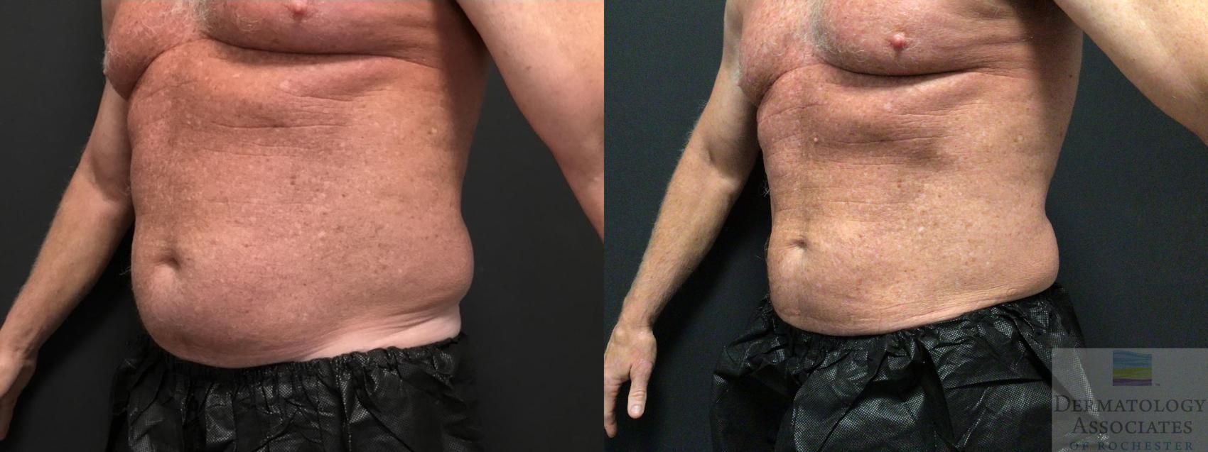Before & After Coolsculpting Case 34 Left Oblique View in Rochester, NY