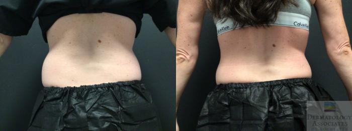 Before & After Coolsculpting Case 36 Back View in Rochester, NY