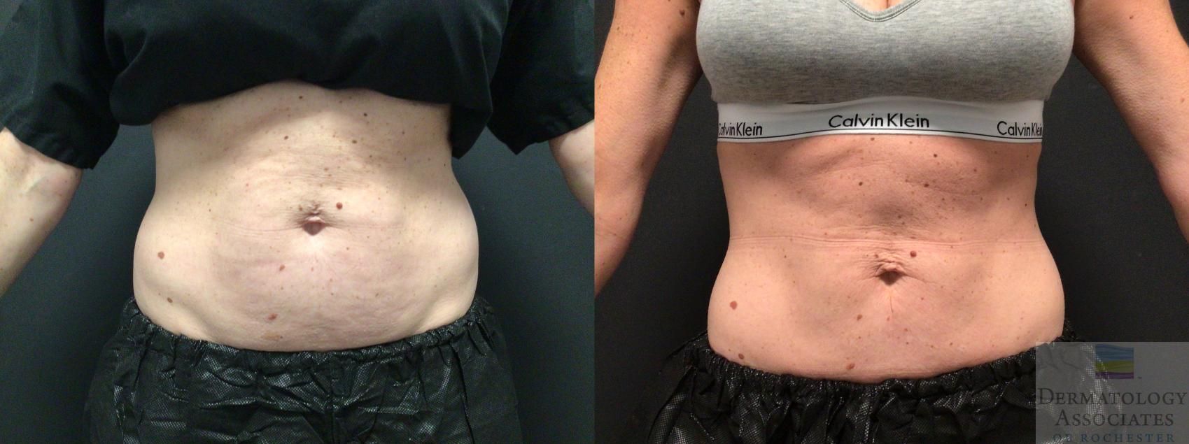 Before & After Coolsculpting Case 36 Front View in Rochester, NY