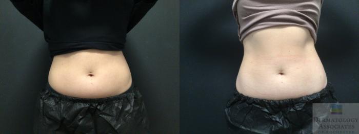 Before & After Coolsculpting Case 45 Front View in Rochester, NY