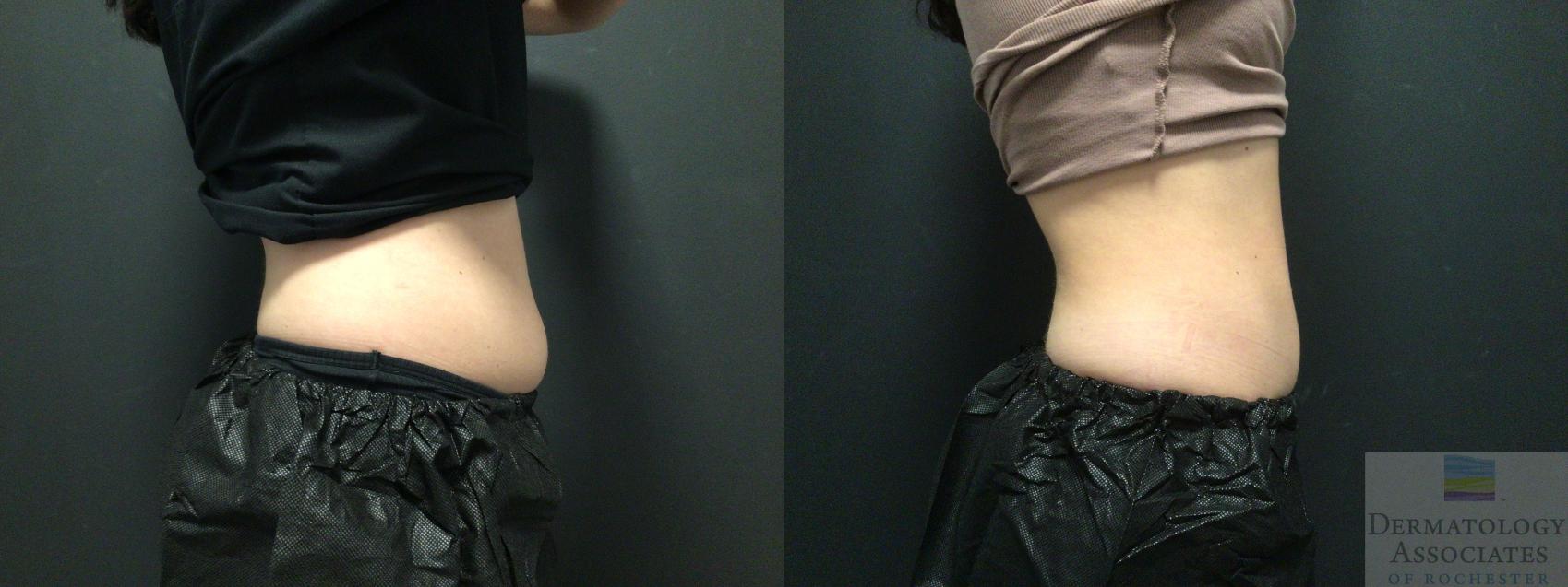 Before & After Coolsculpting Case 45 Right Side View in Rochester, NY