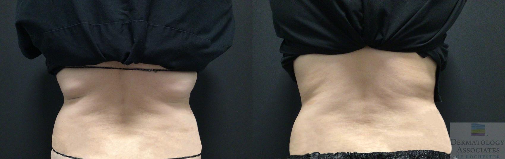 Before & After Coolsculpting Case 49 Back View in Rochester, NY