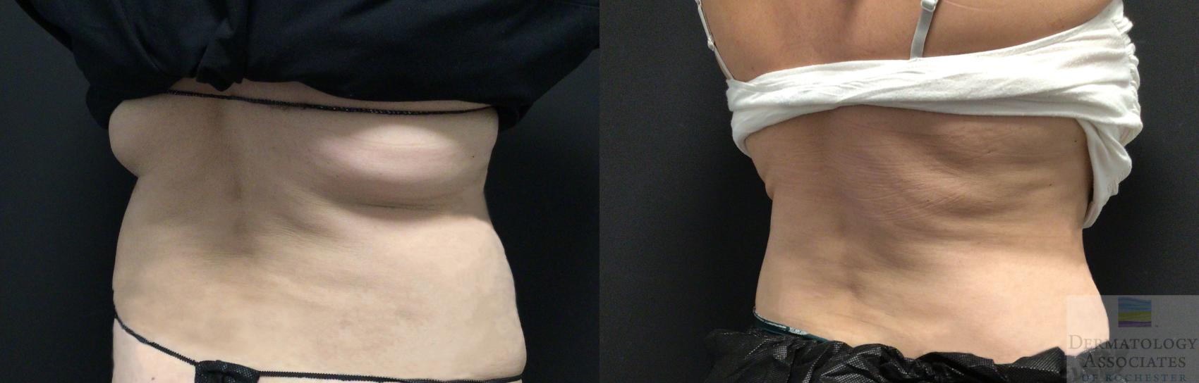 Before & After Coolsculpting Case 49 Right Oblique View in Rochester, NY